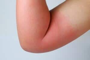 Arm mit Allergie Arm mit Allergie