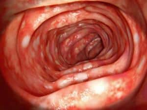 Colitis Ulcerosa Colitis Ulcerosa