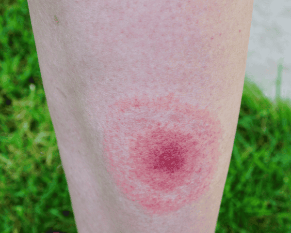 Erythema Migrans Erythema Migrans